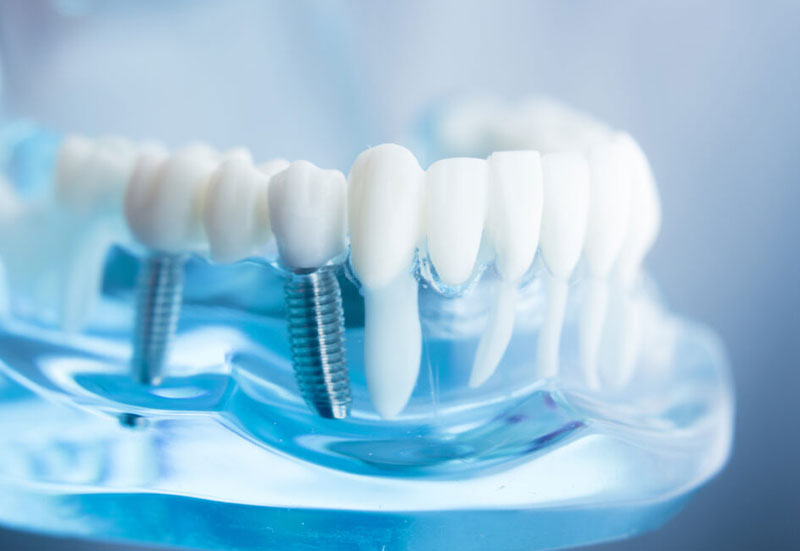 Implantologia i protetyka