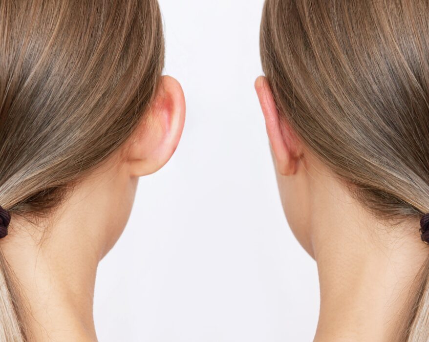 korekta uszu, korekta odstających uszu, ilustracja możliwego rezultatu operacji